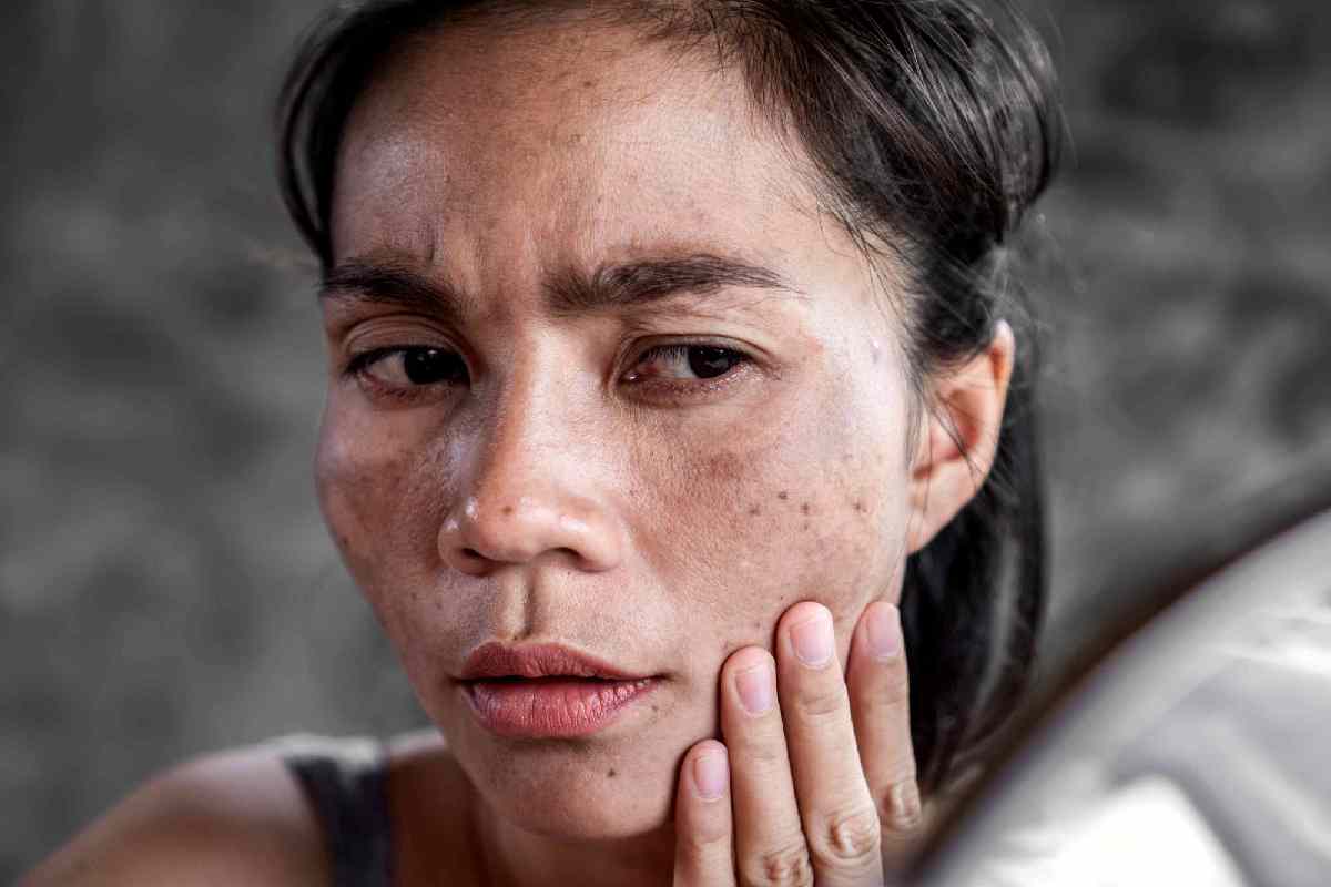 Remove Dark Spots on Face Tang