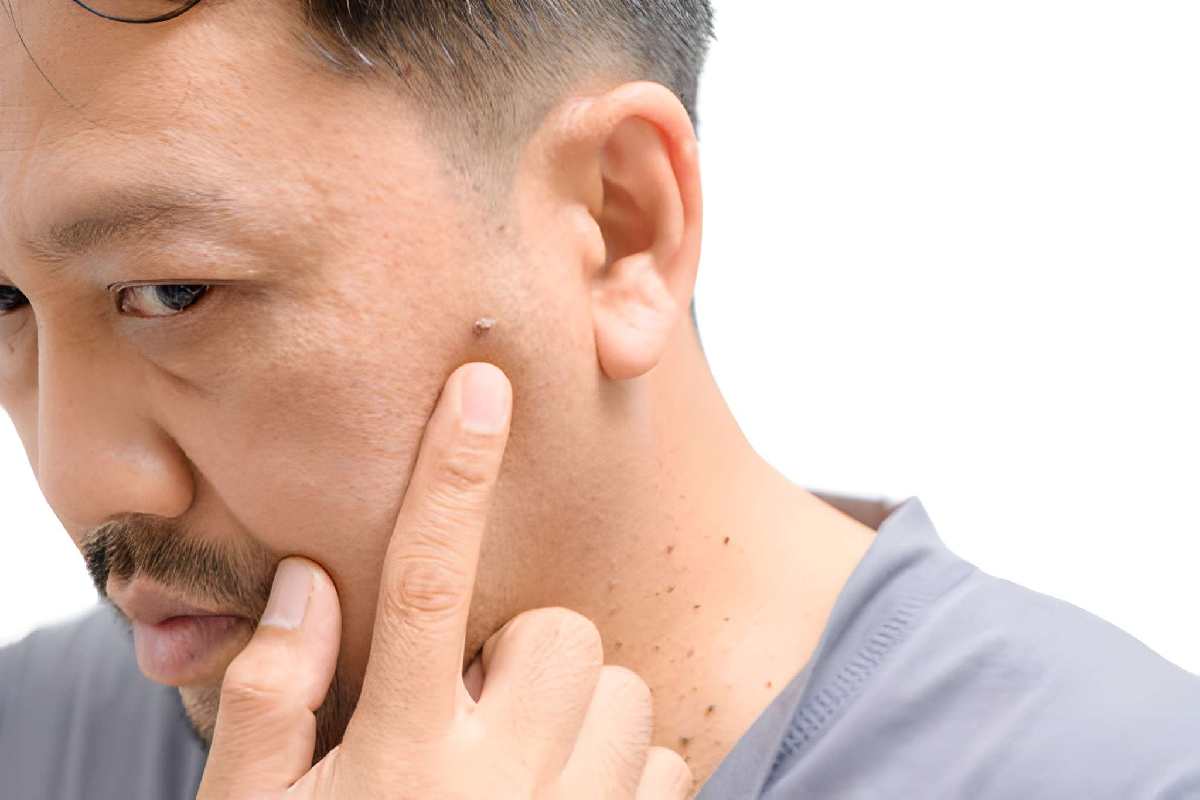 Wart And Skin Tag