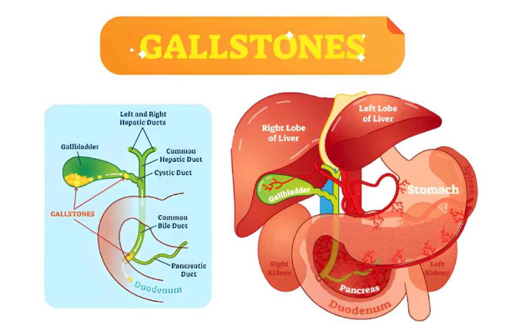 Which Size of Gallbladder Stone Is Dangerous