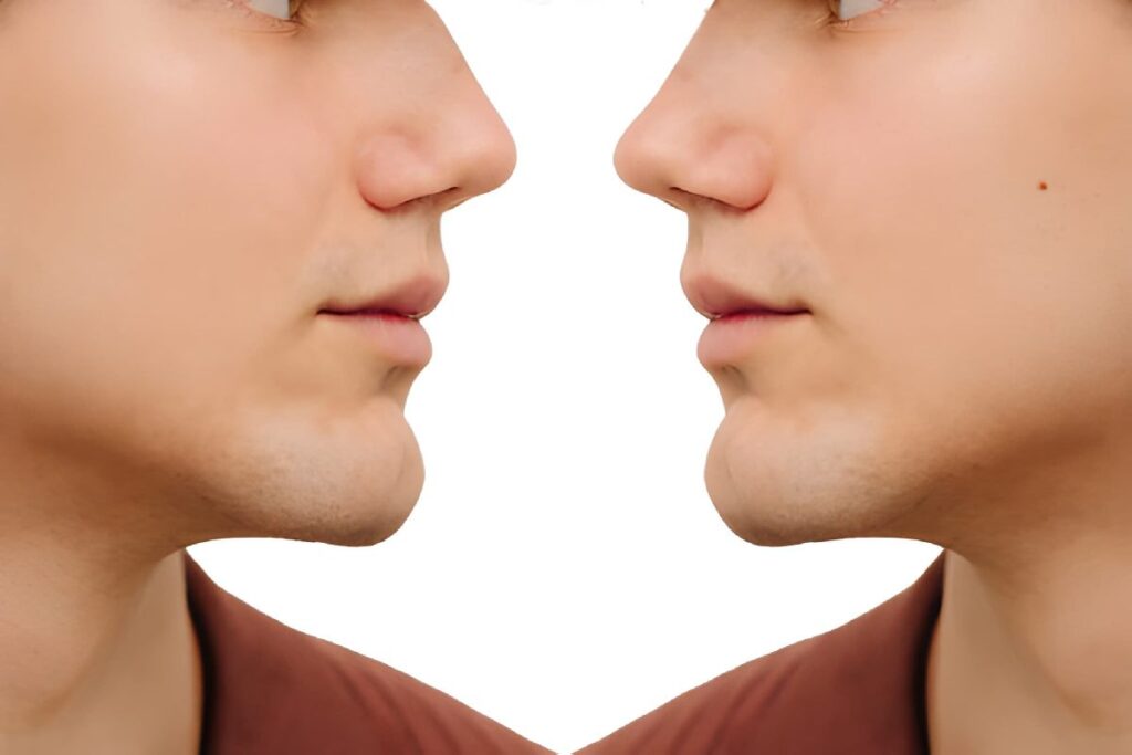 Septoplasty Before and After