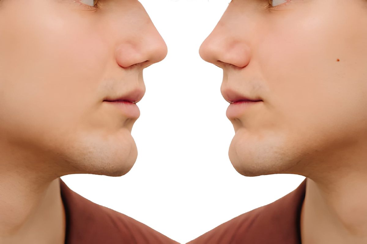 Septoplasty Before and After
