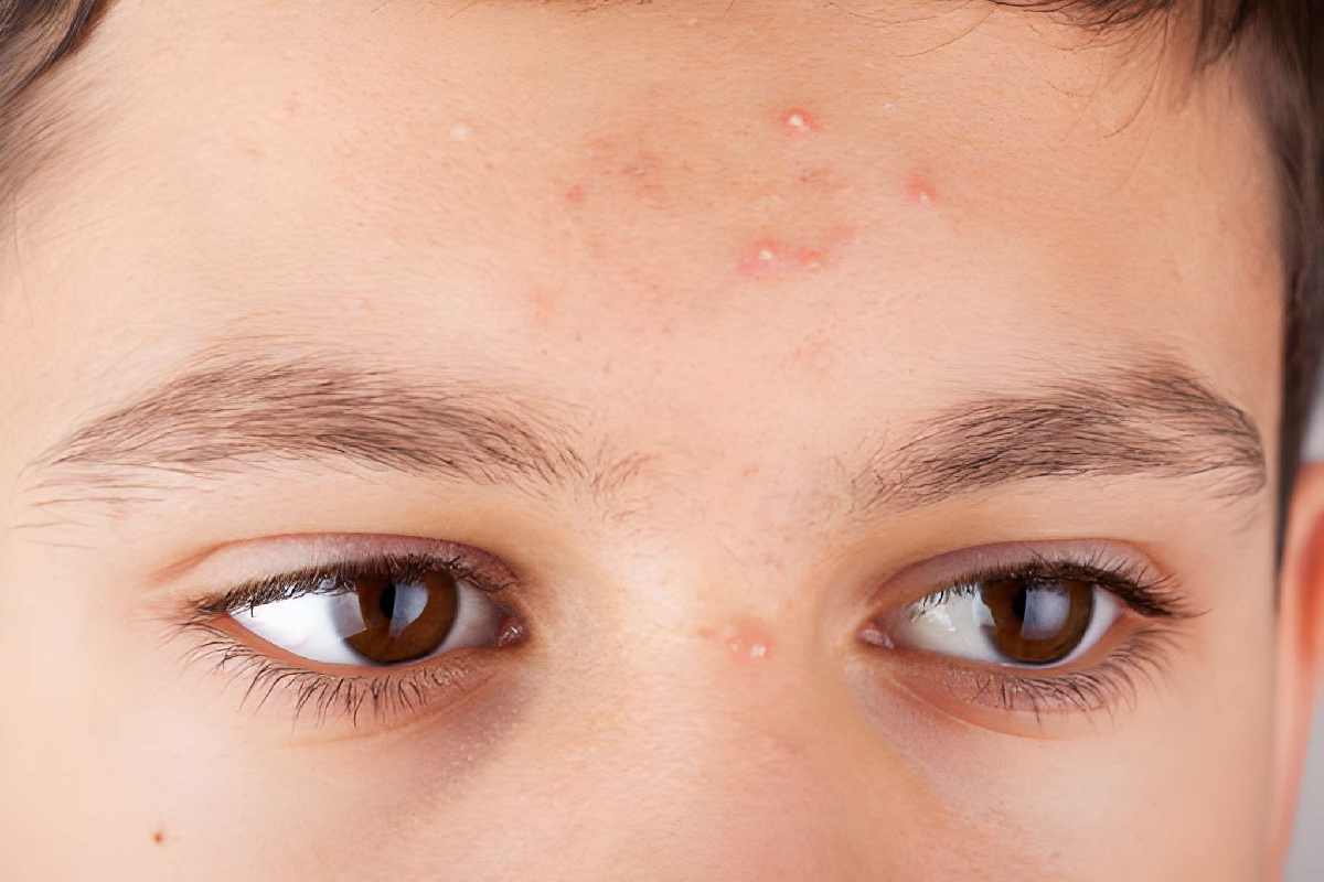 White Pimple