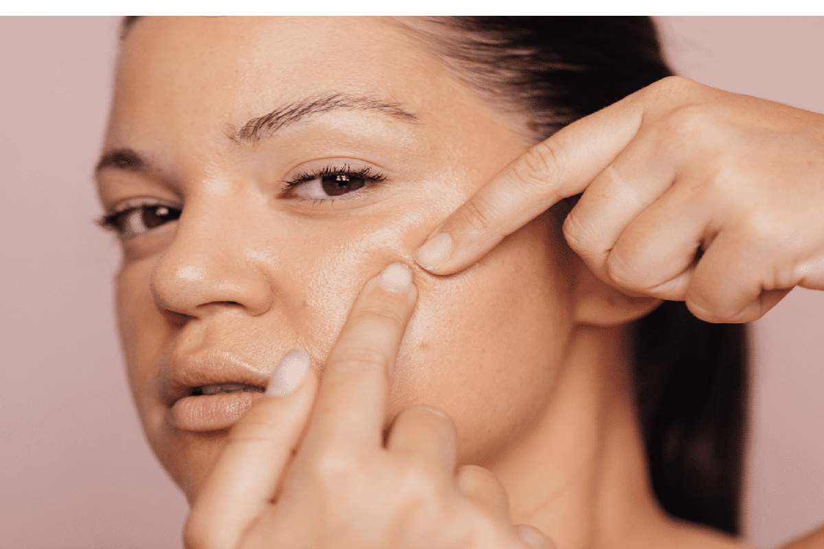 How to Get Rid of Fungal Acne